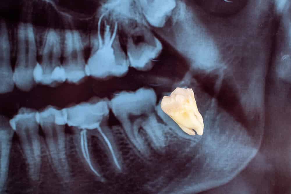 הקשר בין עקירת שן בינה ויישור שיניים